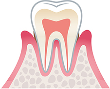 軽度歯周炎